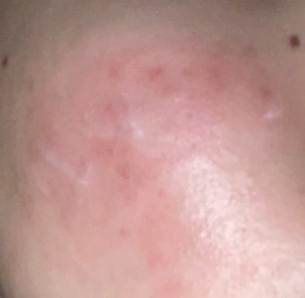 ディフェリンゲル0.1%/ガルデルマ/その他スキンケアを使ったクチコミ(2枚目)