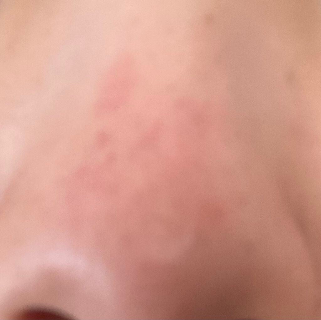 FDR アクネケア 化粧液/ファンケル/化粧水を使ったクチコミ(2枚目)