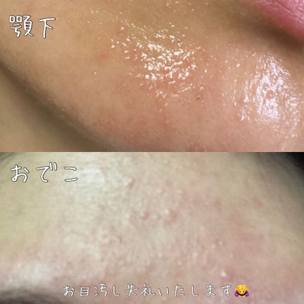 マキロン アクネージュ メディカルクリーム	(医薬品)	/マキロン/その他を使ったクチコミ(3枚目)