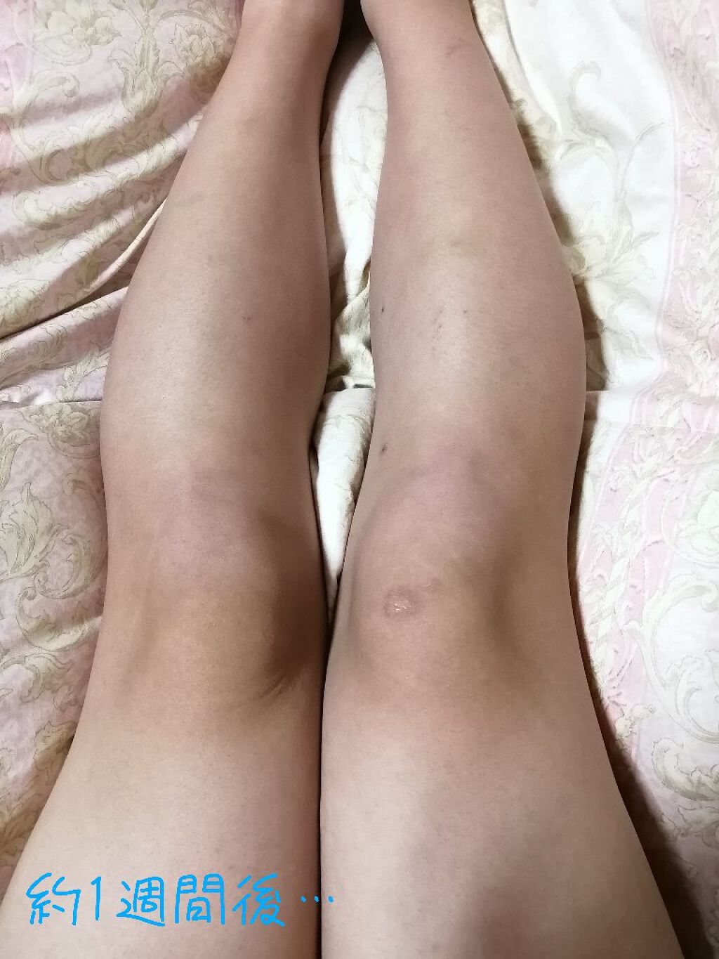 モテ肌  除毛パッド/セリア/ムダ毛ケアを使ったクチコミ（3枚目）