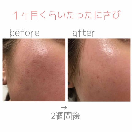 バイオイル/バイオイル/フェイスオイルを使ったクチコミ(4枚目)