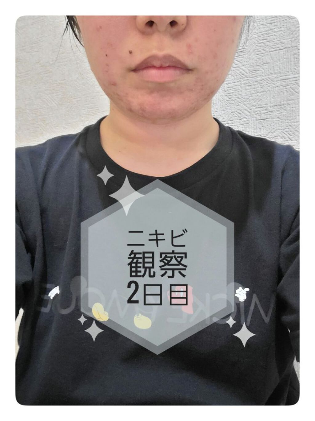 九州育ちのじゃがいもちゃん on LIPS 「汚肌注意⚠️○ニキビ観察2日目○前日と余り変わらず。何年間もい..」(1枚目)