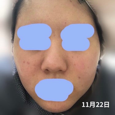 せんり on LIPS 「汚肌注意⚠️2、3枚目顔の写真あります、ほんとに汚いので苦手な..」（3枚目）