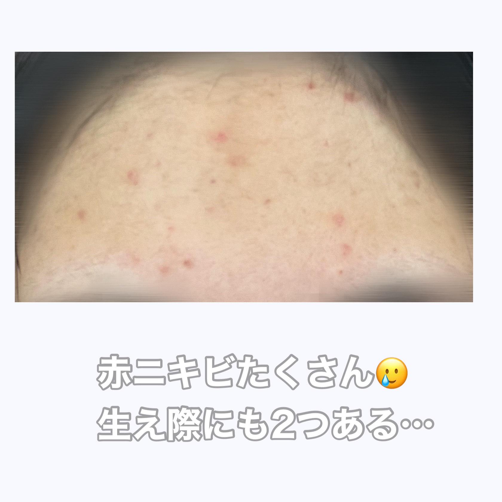 オードムーゲ 薬用ローション（ふきとり化粧水）/オードムーゲ/拭き取り化粧水を使ったクチコミ（2枚目）