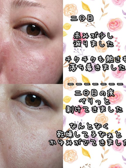 ダーマスキンピーリング/BQCELL/その他キットセットを使ったクチコミ(3枚目)