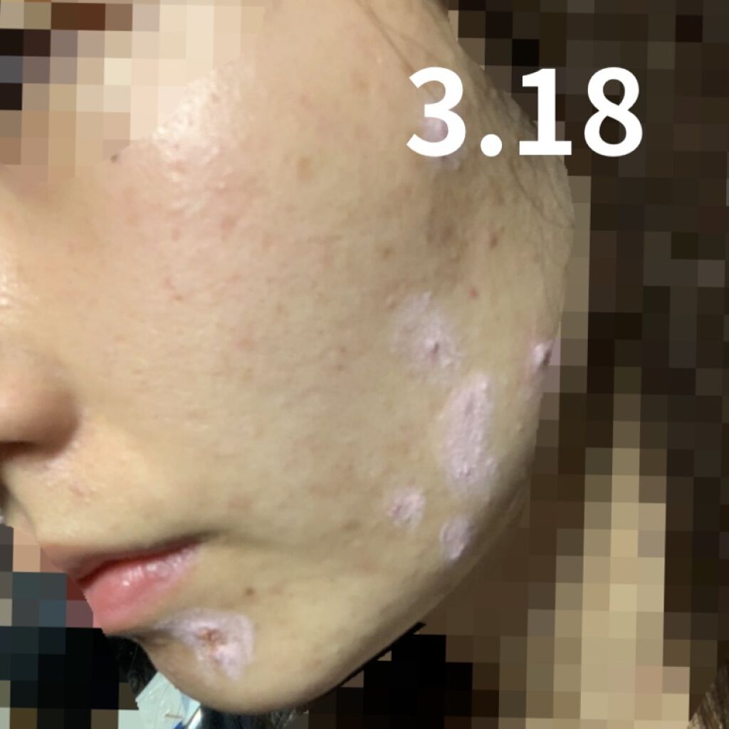 薬用 クリアローション M(しっとりタイプ)/オルビス/化粧水を使ったクチコミ（3枚目）