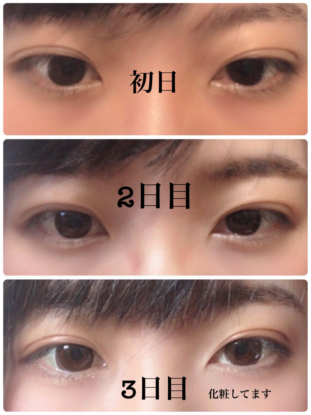 二重整形/その他を使ったクチコミ（2枚目）