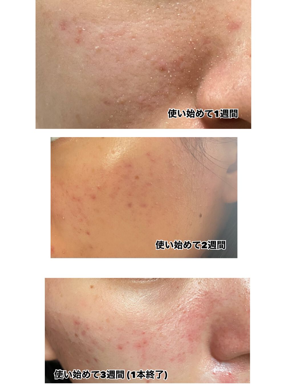 ペアアクネクリームW(医薬品)/ペア/その他を使ったクチコミ（2枚目）