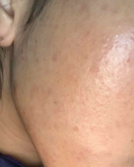 キズパワーパッド/バンドエイド/その他を使ったクチコミ(1枚目)