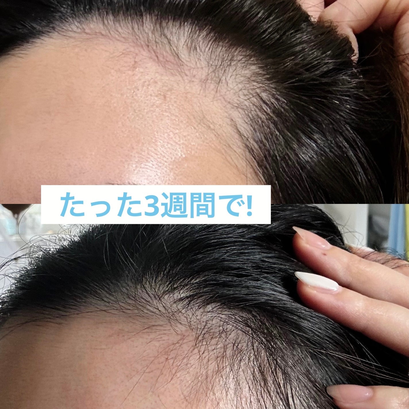 薬用 メディカル アンチヘアロスセラム/L'OCCITANE/頭皮ローションを使ったクチコミ(3枚目)