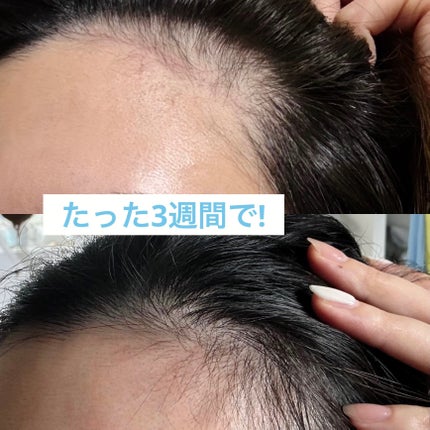 薬用 メディカル アンチヘアロスセラム/L'OCCITANE/頭皮ローションを使ったクチコミ(3枚目)