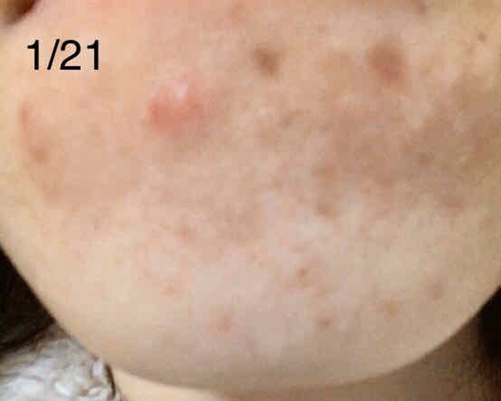 ペアアクネクリームW(医薬品)/ペア/その他を使ったクチコミ(2枚目)