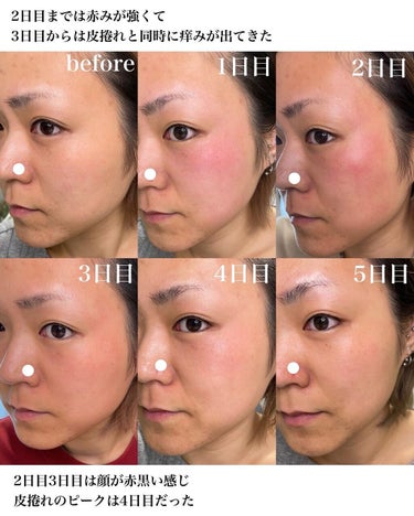 ダーマスキンピーリング|BQCELLの口コミ - 私の肌は生まれ変わった