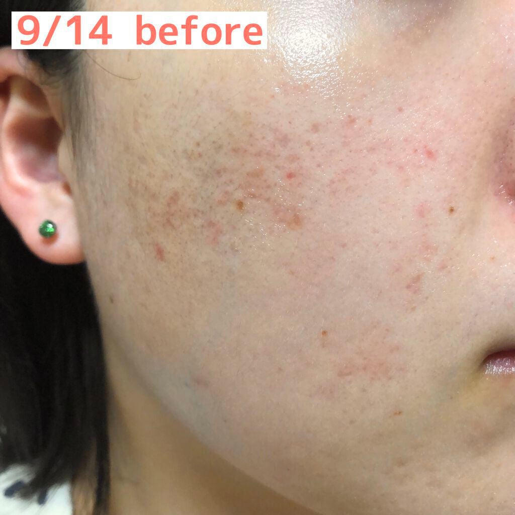 ビタアクナル TX ナイトクリーム/Dr.Different/フェイスクリームを使ったクチコミ(3枚目)