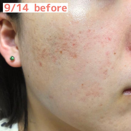 ビタアクナル TX ナイトクリーム/Dr.Different/フェイスクリームを使ったクチコミ(3枚目)