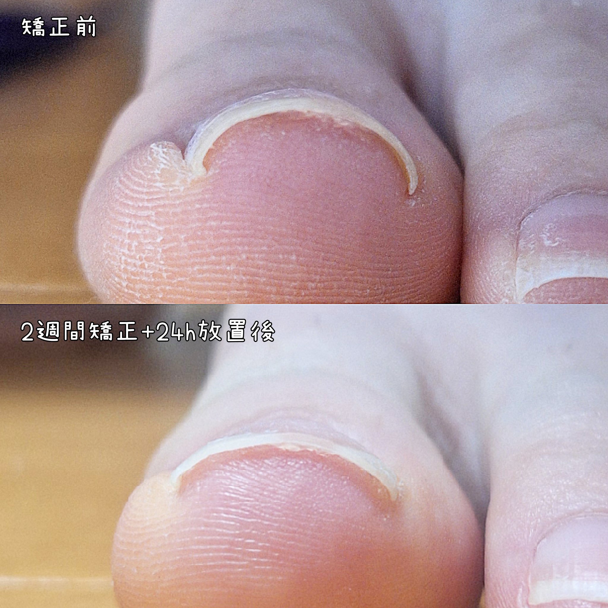 Ingrown Toenails Correction Wire/jinail/ネイル用品を使ったクチコミ（3枚目）