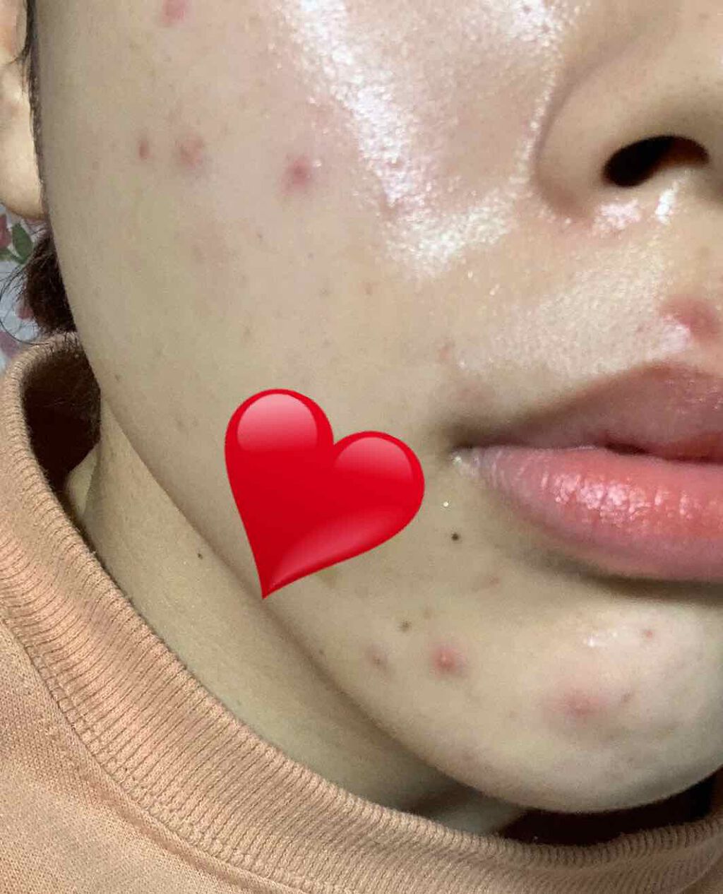 a on LIPS 「初投稿です!私は去年の11月ごろから突然大量の大人ニキビが発生..」(2枚目)