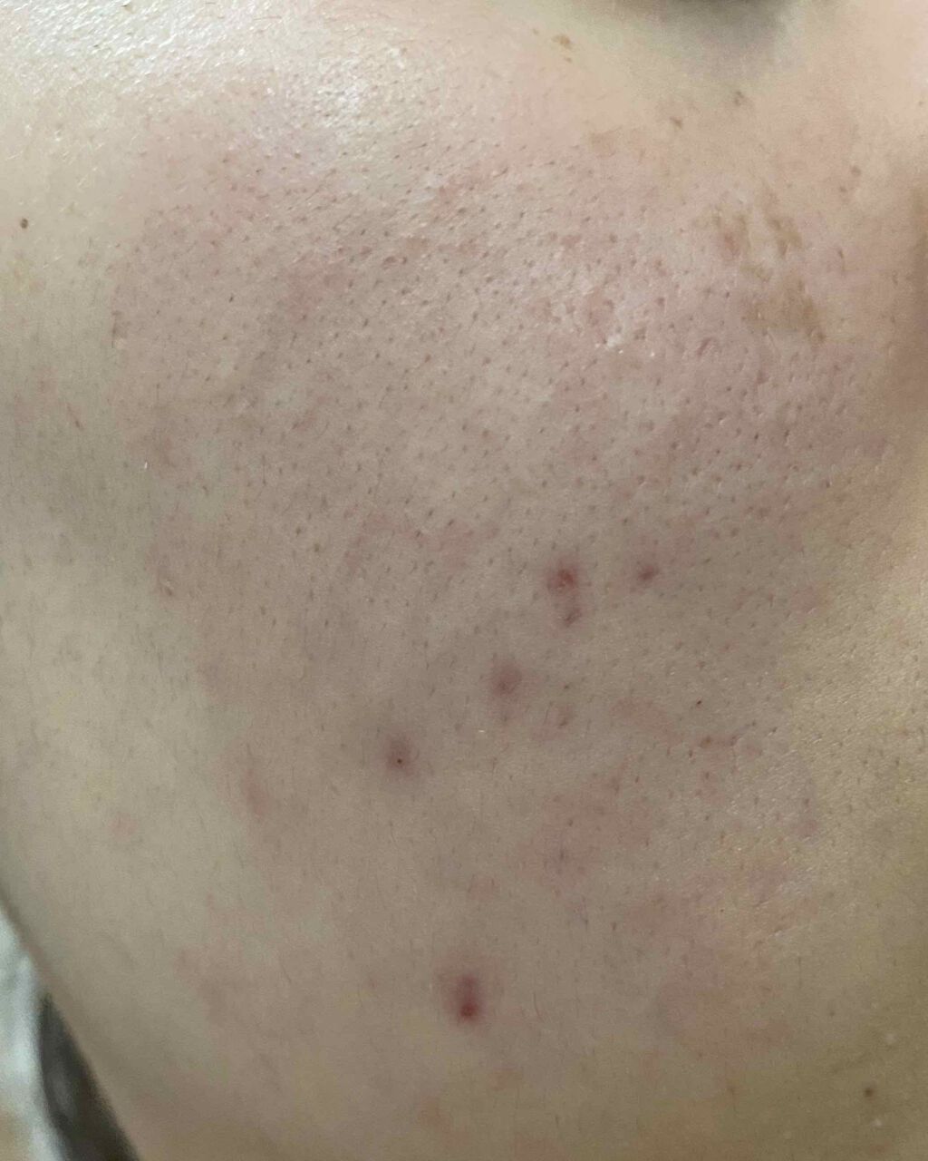 薬用アクネホワイトニング ジェル(部分用美容液)/DHC/美容液を使ったクチコミ(2枚目)