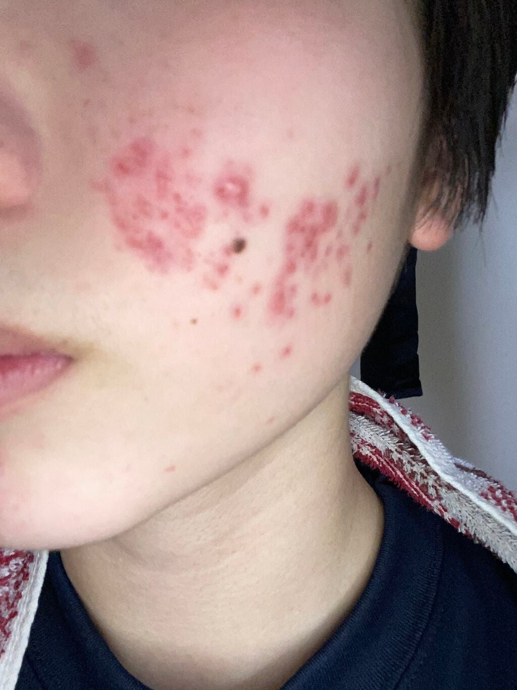 のの on LIPS 「約1ヶ月が経ちました。おでこは良くなってきてますがまだほっぺた..」(1枚目)