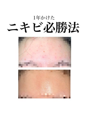 キュレル 皮脂トラブルケア 化粧水のクチコミ「私の肌質は混合肌です。
額とこめかみにニキビができるタイプでした。

※今回記載した医薬品の使.....」（1枚目）