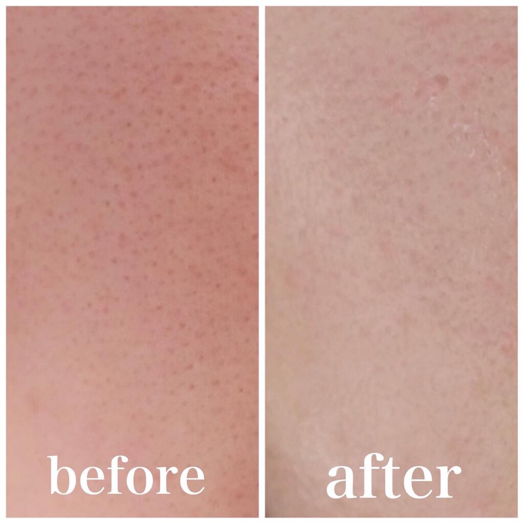 PLUMINUS/mous./美顔器・マッサージを使ったクチコミ(9枚目)