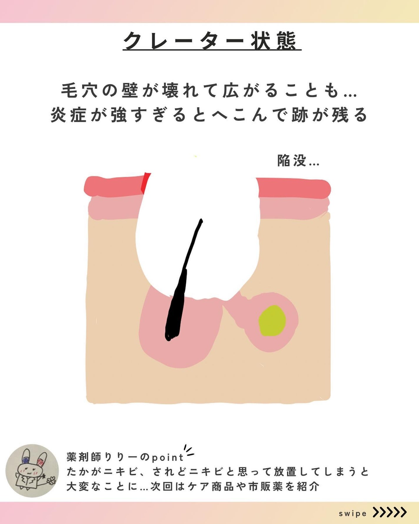 りりみーだ | コスメ×薬剤師 on LIPS 「お薬投稿の日ニキビシリーズ第三弾ですニキビの種類を段階と順序を..」(9枚目)