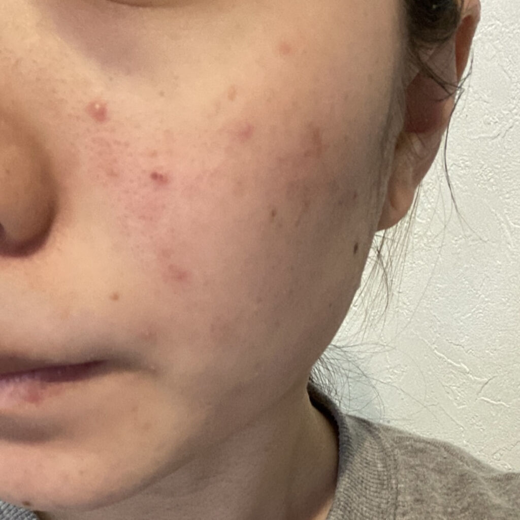 薬用しみ対策 美白化粧水/メラノCC/化粧水を使ったクチコミ（2枚目）