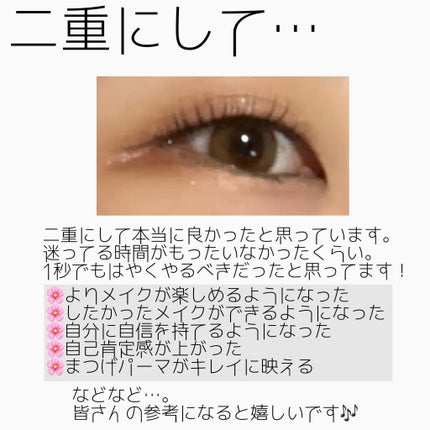 NANO@フォロバ! on LIPS 「二重整形ダウンタイム記録/抜糸してから半年が経ちました。約1ヶ..」(6枚目)