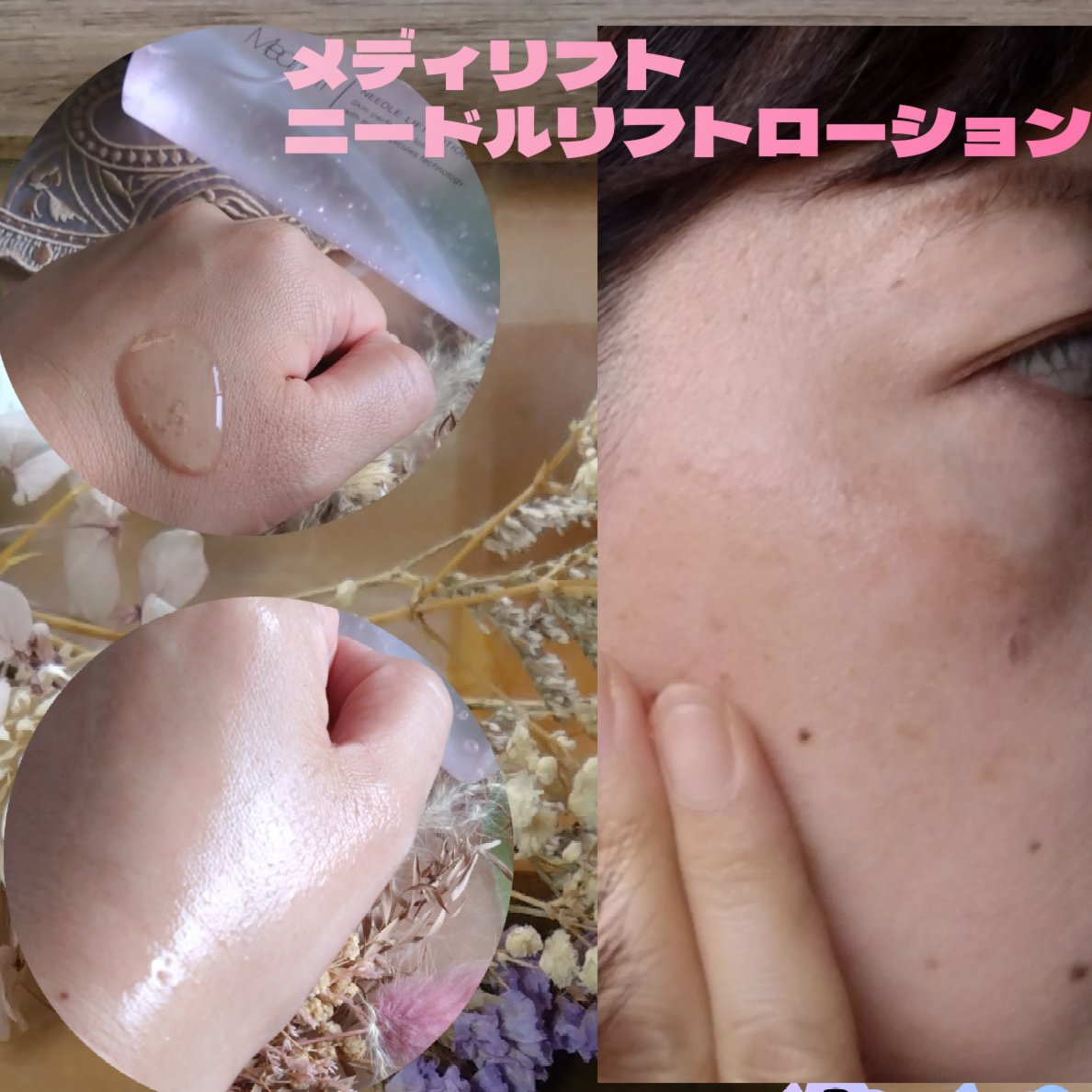 メディリフト ニードルリフトピールセラム/YA-MAN TOKYO JAPAN/美容液を使ったクチコミ（1枚目）