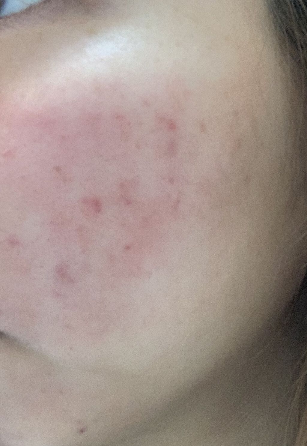 デュアック配合ゲル/美容皮膚科/フェイスクリームを使ったクチコミ（1枚目）