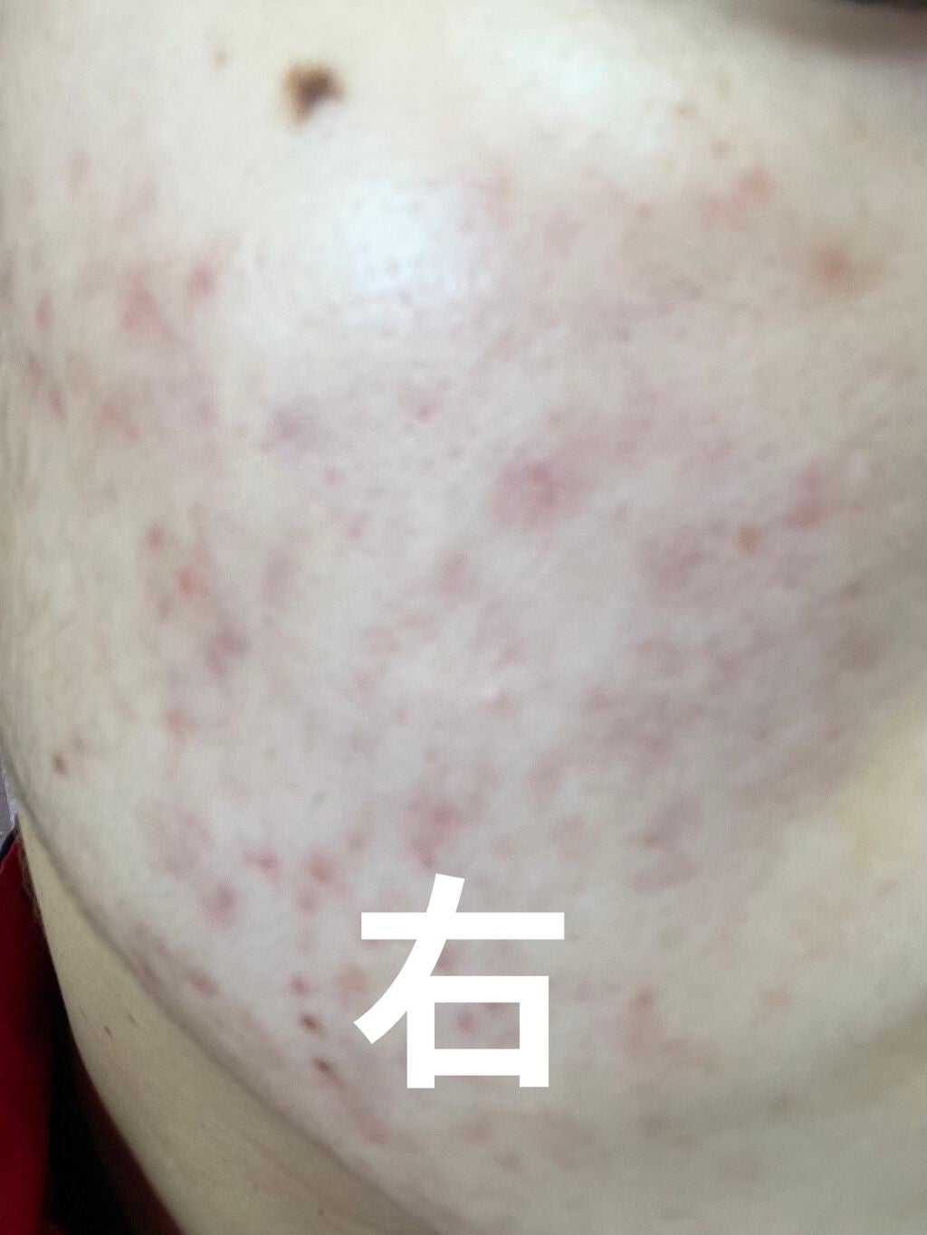 ニキビJK on LIPS 「汚肌からお肌への道!!8週間目!投稿が1日遅れてしまってすいま..」(2枚目)