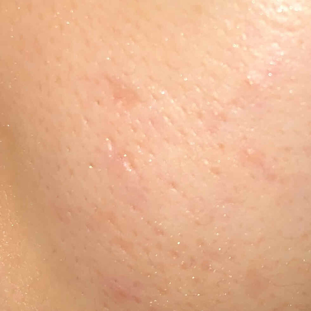 ベピオゲル/マルホ株式会社/その他を使ったクチコミ（2枚目）