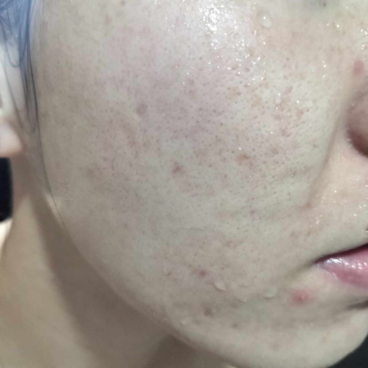 miina@汚肌工事録⚠️ on LIPS 「10/20の#汚肌工事録あれてる…😂すとれすっすね。❤スキンケ..」(1枚目)