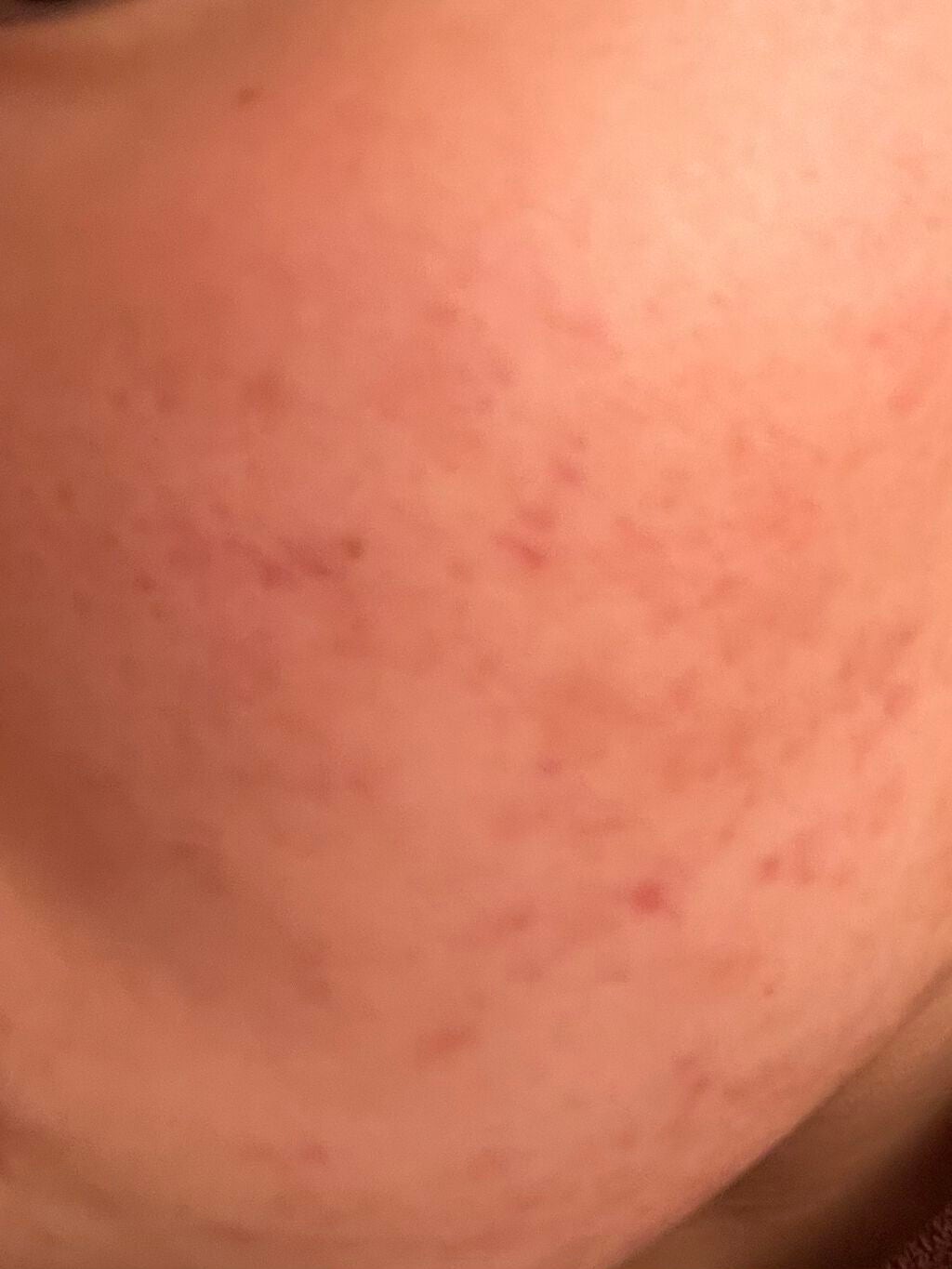 ニキビJK on LIPS 「汚肌からお肌への道!!9週間目!!今回のこの写真はホントに起き..」(3枚目)