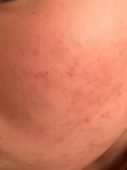 ニキビJK on LIPS 「汚肌からお肌への道!!9週間目!!今回のこの写真はホントに起き..」(3枚目)