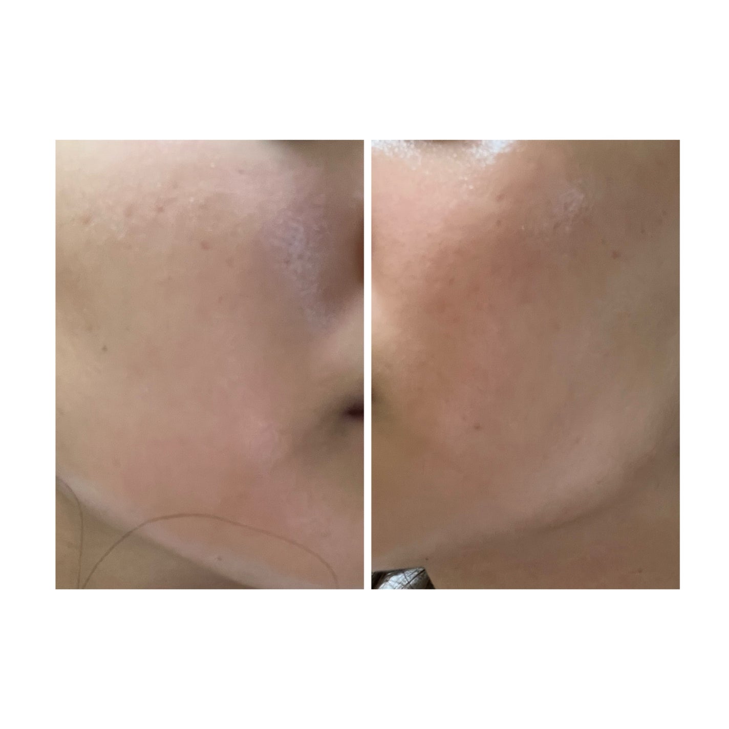 ぽむ on LIPS 「2023.9.13皮膚科に受診 エピデュオとヘパリン処方1枚目..」(4枚目)