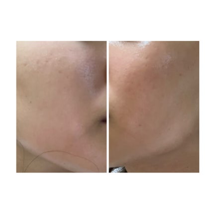 ぽむ on LIPS 「2023.9.13皮膚科に受診 エピデュオとヘパリン処方1枚目..」(4枚目)