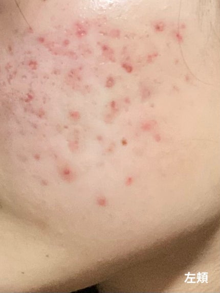 AHA 30% + BHA 2% Peeling Solution/The Ordinary/ピーリングを使ったクチコミ(3枚目)