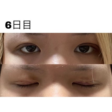 七瀬 on LIPS 「初投稿失礼します!この度ついに念願の二重埋没をしてきました〜!..」(8枚目)