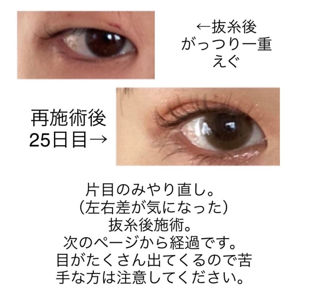 YuMi on LIPS 「埋没の再施術しました。経過まとめです。数ヶ月前に埋没施術しまし..」(2枚目)