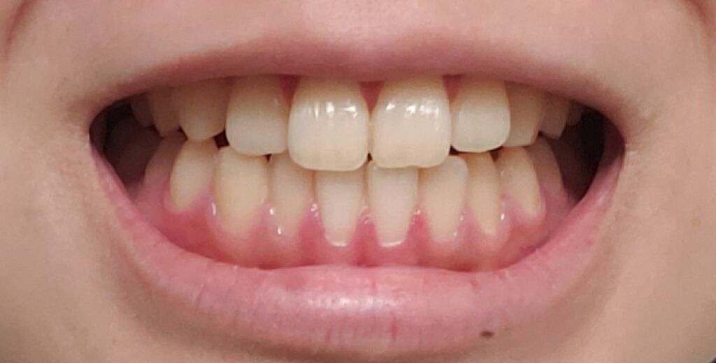 アパガードプレミオ/アパガード/歯磨き粉を使ったクチコミ（2枚目）