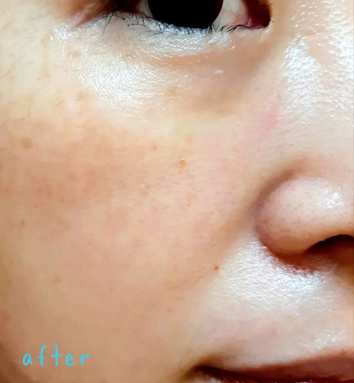 アカルミー化粧水/ワイズ/化粧水を使ったクチコミ(7枚目)