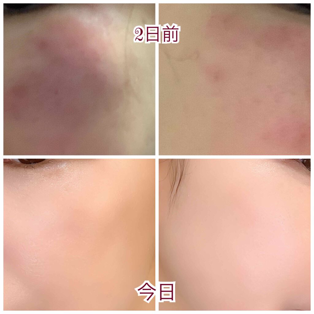 オロナインH軟膏 (医薬品)/オロナイン/その他を使ったクチコミ(2枚目)