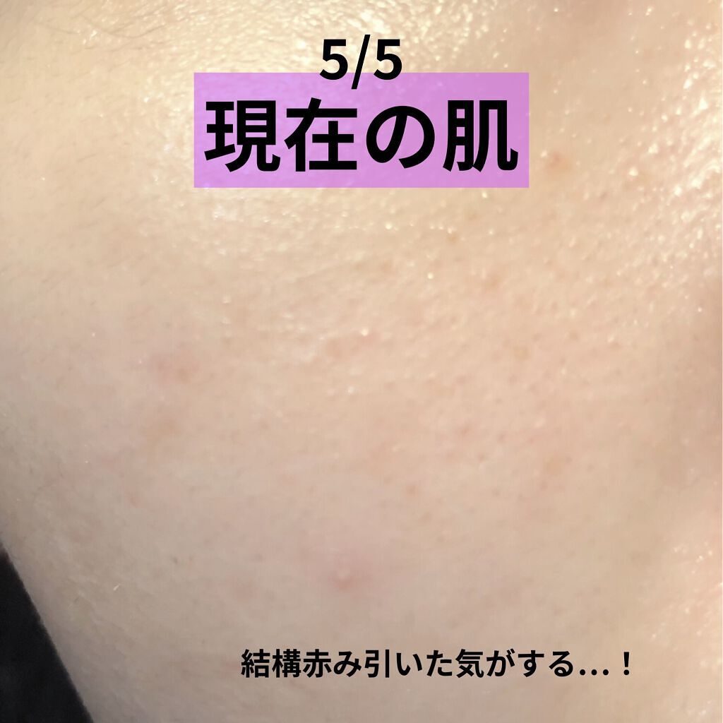 オードムーゲ 薬用ローション（ふきとり化粧水）/オードムーゲ/拭き取り化粧水を使ったクチコミ（3枚目）