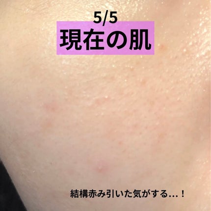 オードムーゲ 薬用ローション(ふきとり化粧水)/オードムーゲ/拭き取り化粧水を使ったクチコミ(3枚目)