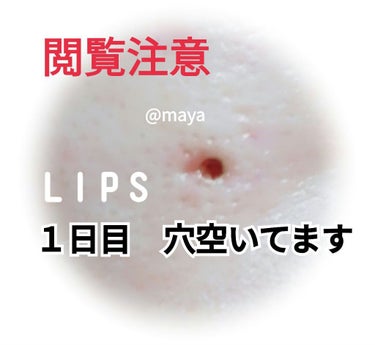 maya🧡 on LIPS 「　　　ホクロ除去(同じ箇所３回目)してきました❗みなさん、こん..」（2枚目）