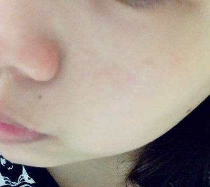 ツルリ 皮脂吸い出し 部分用パック ガスール&レッドパワー/ツルリ/洗い流すパック・マスクを使ったクチコミ(2枚目)