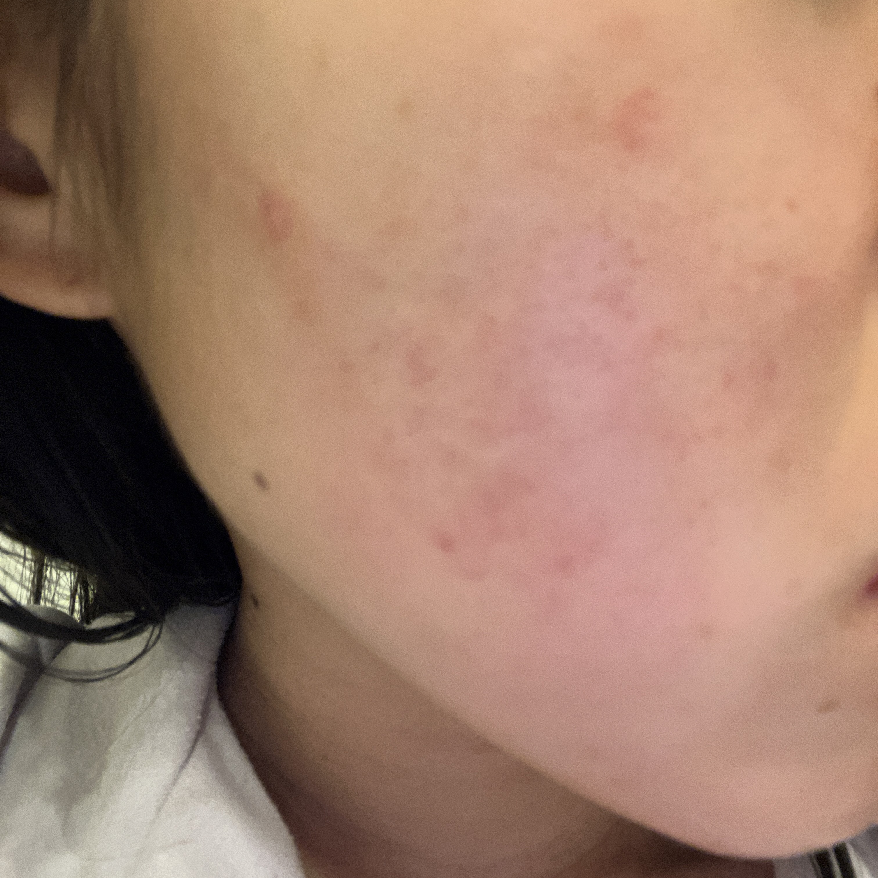 薬用 しみ 集中対策 美容液/メラノCC/美容液を使ったクチコミ（2枚目）