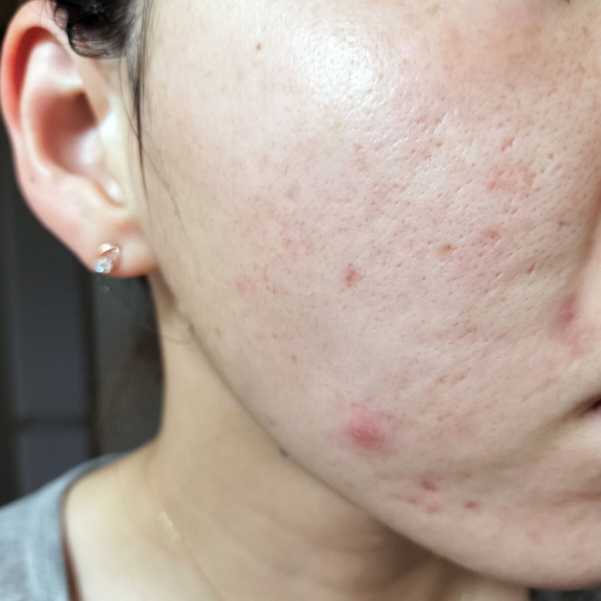マデカソ 美容液 A Pieuを使った口コミ 8 16 の 汚肌工事録なんとなくごわ By Miina 汚肌工事録 混合肌 代後半 Lips