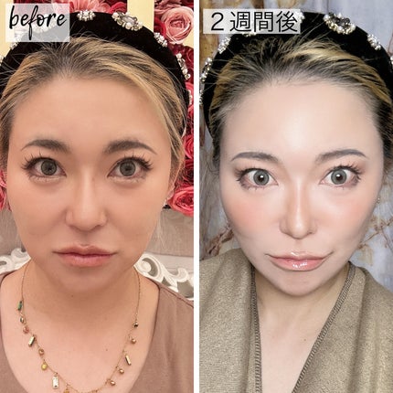 5児ママ ゆかこ♡フォロバ100 コメください on LIPS 「@a_clinic_sendaiにいってきました♡こんにちは女..」(4枚目)